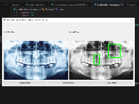 (Xử lí ảnh) Chương trình phát hiện bệnh lí về răng sử dụng thuật toán Canny và Gaussian Blur Python